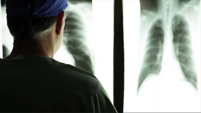 Akutni respiratorni distres sindrom