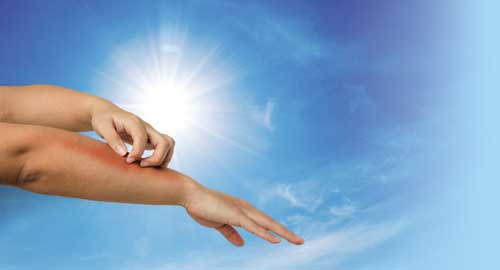 Alergije na sunce